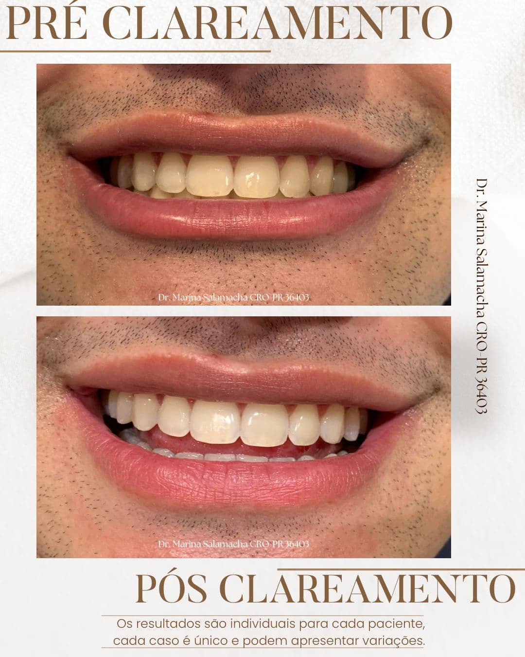 Resultado de Clareamento Dental