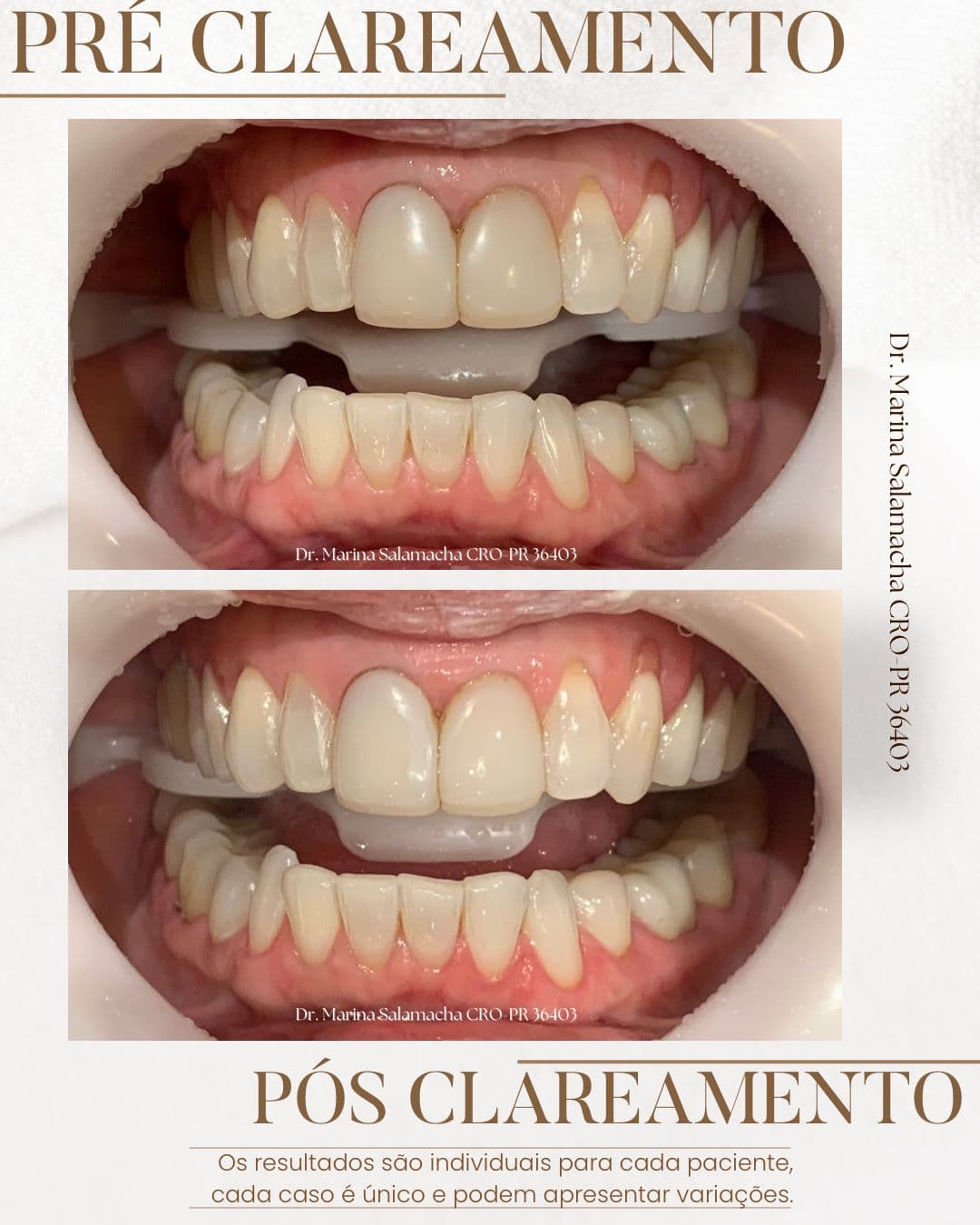 Resultado de Clareamento Dental