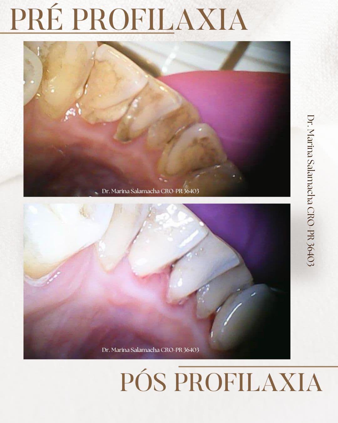 Resultado de Profilaxia (Limpeza)