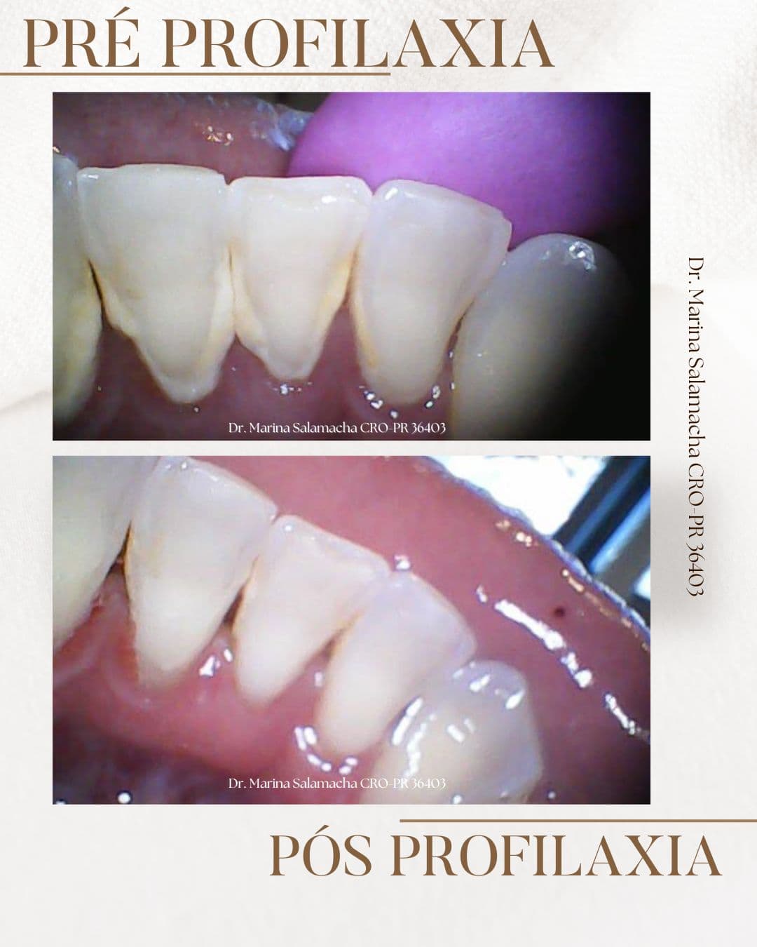 Resultado de Profilaxia (Limpeza)